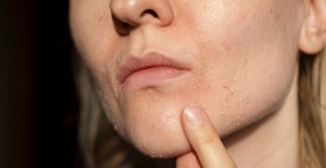 Сухость кожи: причины, симптомы и лечение